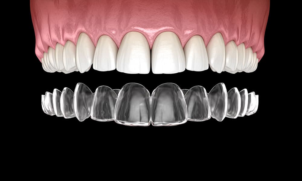 invisalign kaasaegne ortodontia nähtamatud kaped