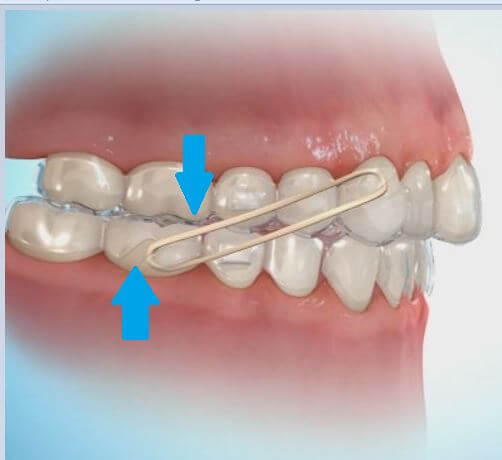 Invisalign-elastikud