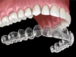 ortodontia kapedega